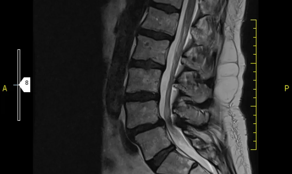 Resonancia magnética de columna