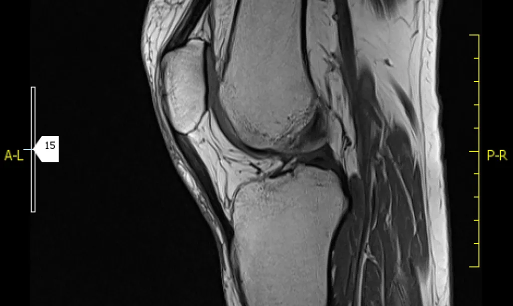 Resonancia magnética de rodilla