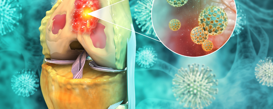 osteosarcoma