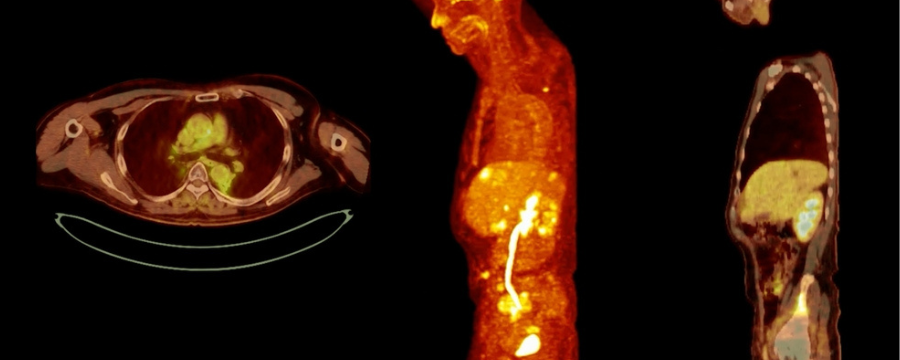 tomografía por emisión de positrones