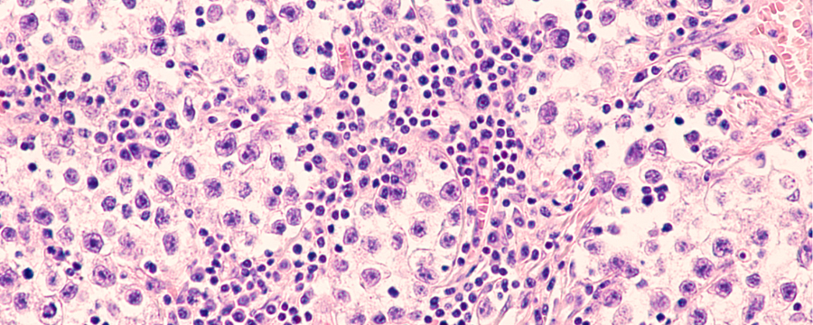 seminoma