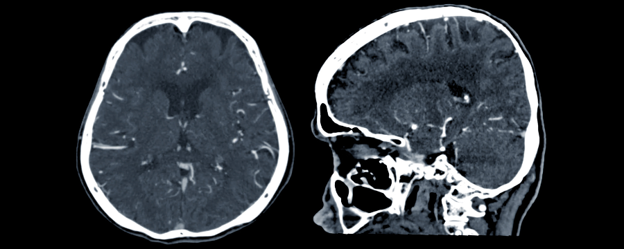 tomografía-axial-computarizada-cerebral